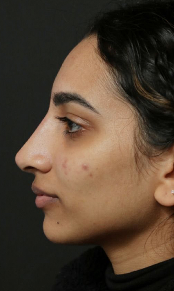 Non Surgical Rhinoplasty Before And After 13 Dr Ashlin Alexander 