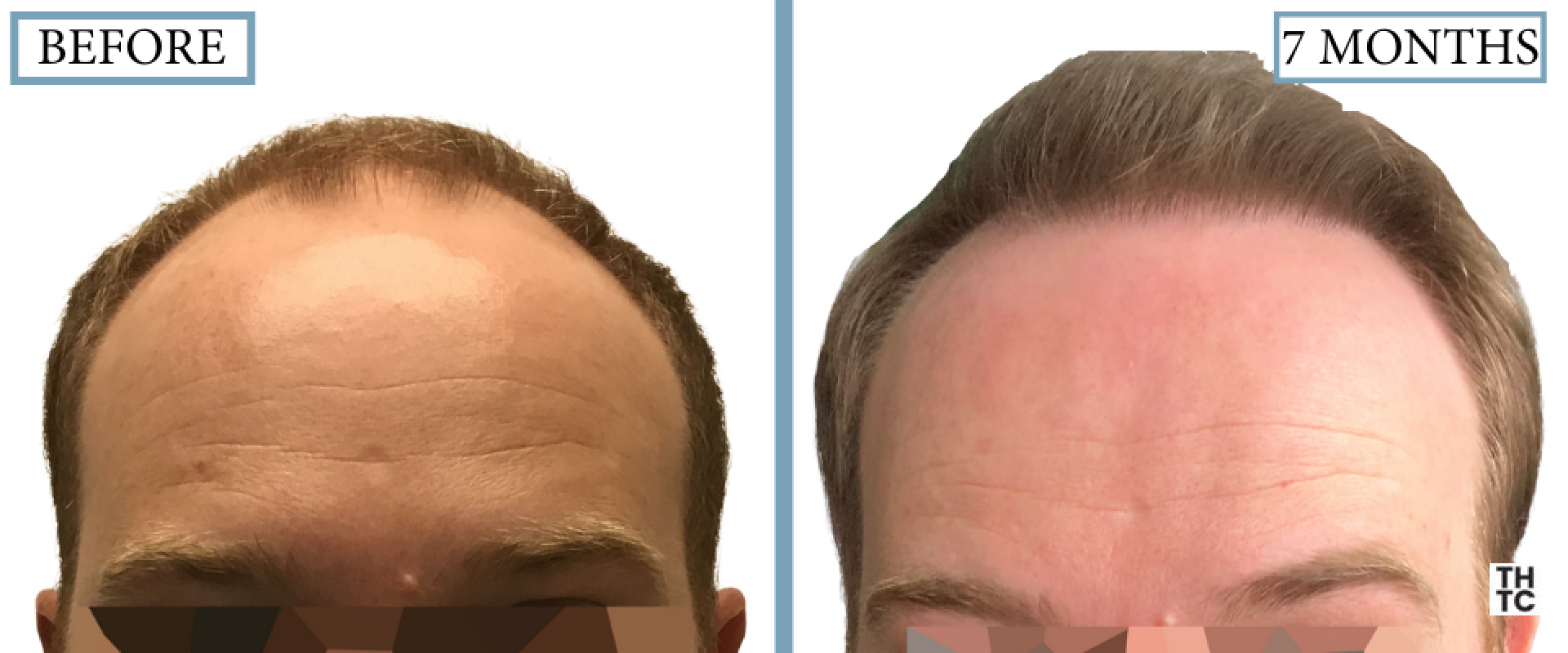 Hair Transplant Toronto  Hair Restoration Toronto